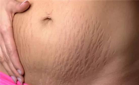满腹妊娠纹如何挥之而去 易缇秀穿戴式养生拯救你